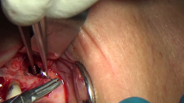 Sinus Lift - Repair of a perforated Sinus Membrane смотреть онлайн