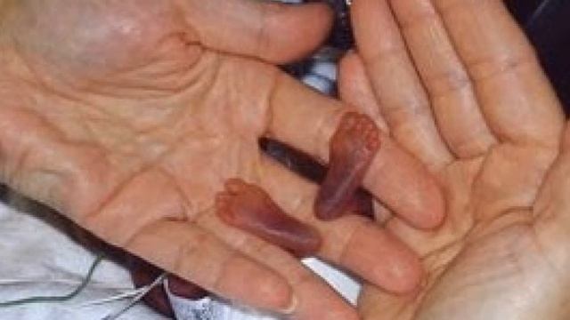 Самый маленький ребенок родился и выжил! Его вес всего 280 грамм. смотреть онлайн