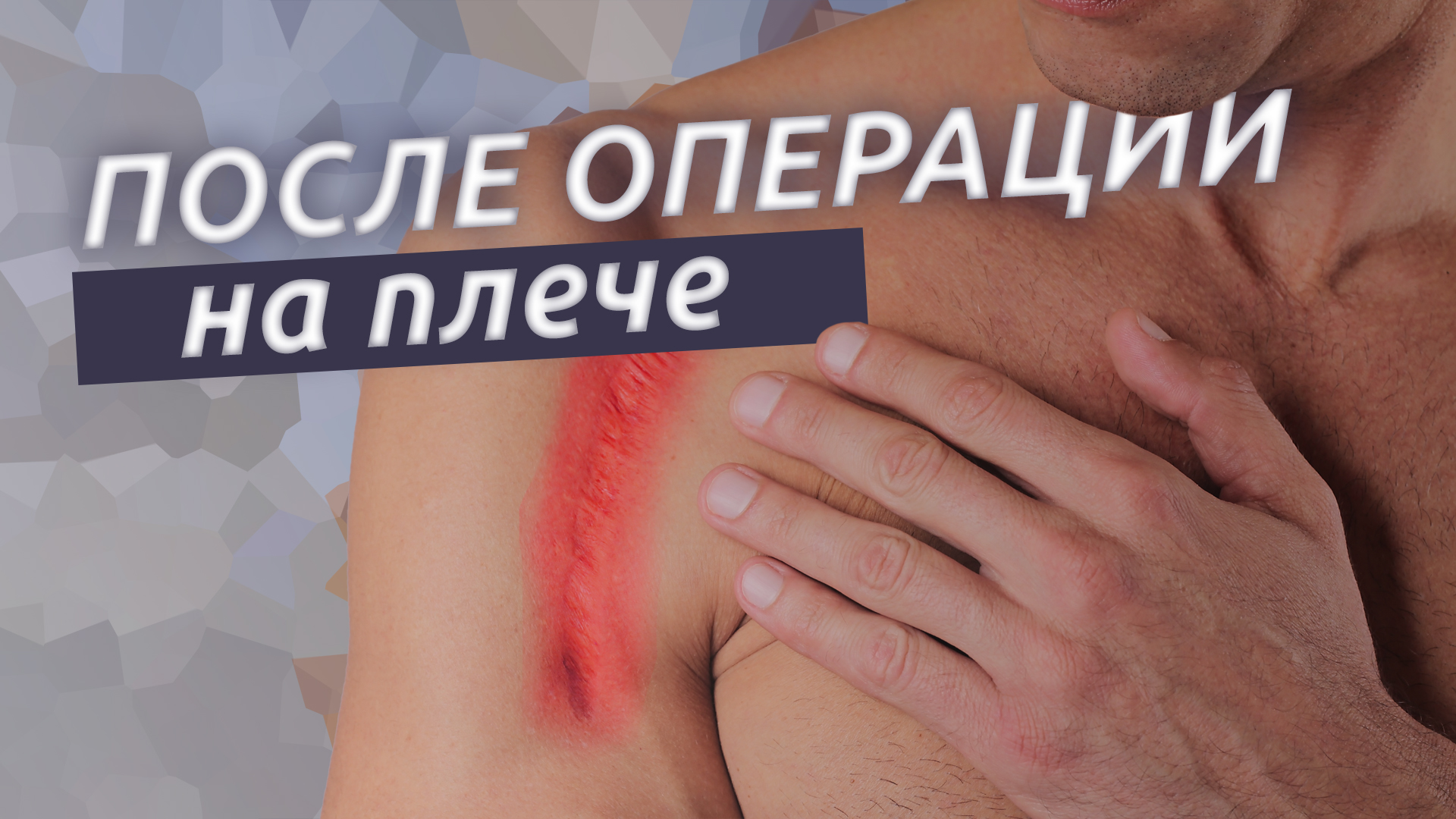 Операции на плече. Первые шаги к здоровому плечу. смотреть онлайн