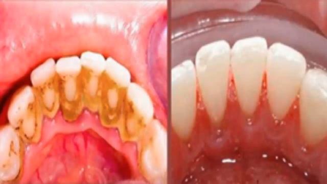 Elimina el sarro y la placa de tus dientes de forma natural en solo 5 minutos con esto смотреть онлайн