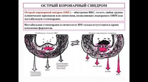 Синдром коронарной недостаточности