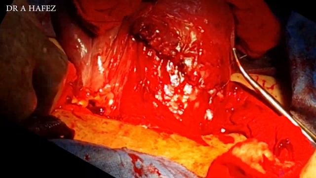 Easy Caesarean Section Technique