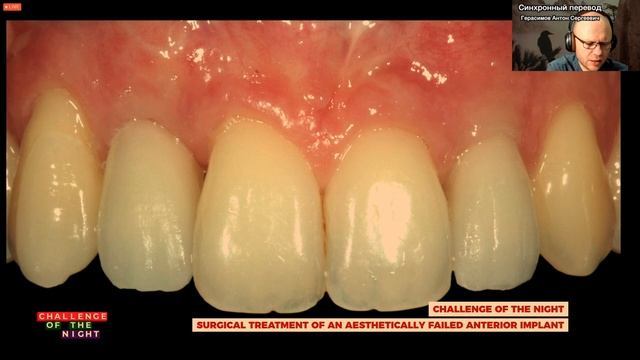 Испытание. Хирургическое лечение эстетической неудачи после имплантации переднем отделе. смотреть онлайн