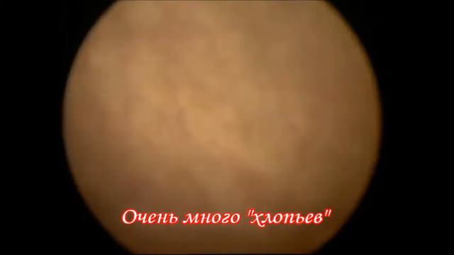 Лейкоплакия мочевого пузыря. Хронический цистит. Цистоскопия. Уретроскопия. Лечение. смотреть онлайн