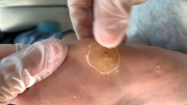 Callus removal from feet&Foot scraping dead skin【Xiao Yan pedicure】#stress 713 смотреть онлайн