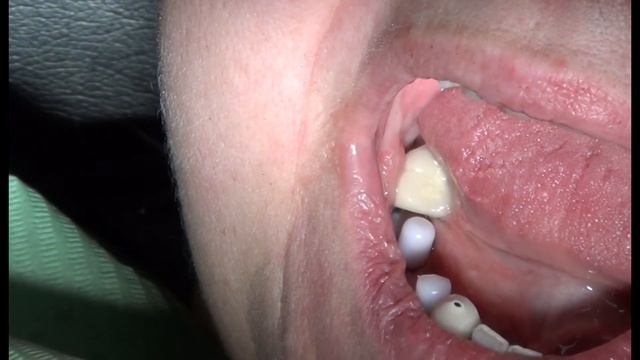 Oral fibroma removal. Dental surgery in Los Angeles Dentistry - U 818.776.0055 смотреть онлайн