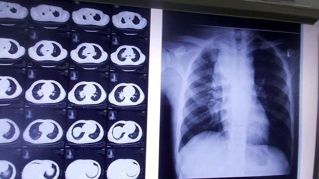 Mediastinal and Hilar lymphadenopathy | Diagnosed Case of Hodgkin lymphoma смотреть онлайн