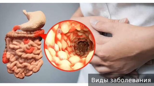 Болезнь Крона. Как лечить болезнь Крона. смотреть онлайн