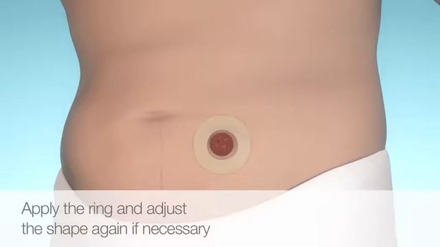 Защитное кольцо Brava моделируемое 2мм, арт 12030, Coloplast смотреть онлайн