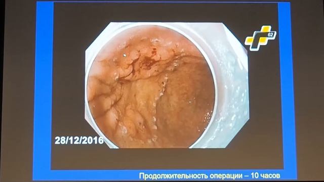 06 Соколов СА Аденокарцинома желудка ESD после ФДТ  и АПК
