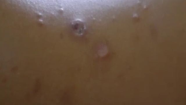 Chemotherapy – III: Chemotherapy of Tuberculosis and Leprosy смотреть онлайн