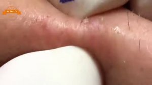 Удаление прыщей с носа и щек Spa G #043