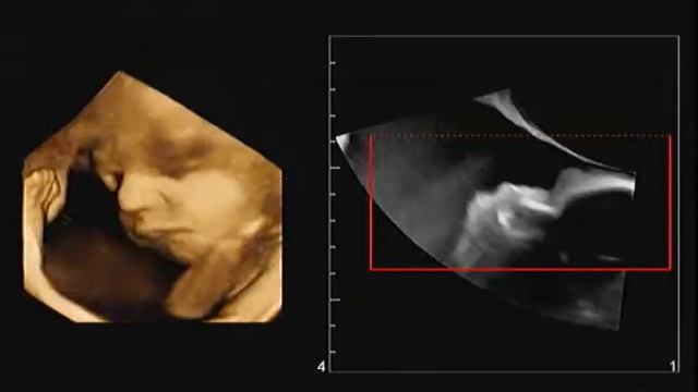 УЗИ 3D/4D в акушерстве в нашем центре смотреть онлайн