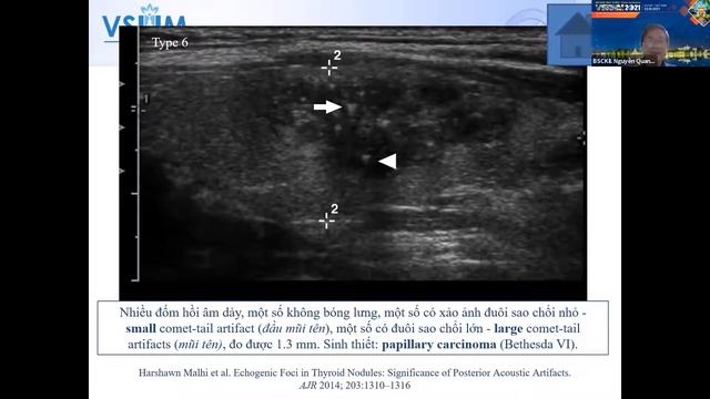 Cập nhật ACR TI RADS Làm thế nào để phân loại cho chính xác смотреть онлайн