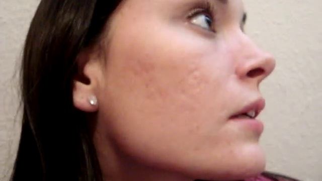 Video Diary for CO2 Fractional Laser for acne scarring (Pre-Procedure) смотреть онлайн