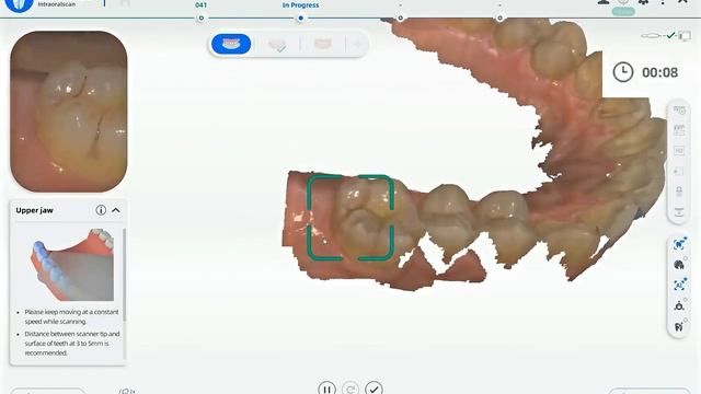 Aoralscan 3 Intraoral Scanner SHINING 3D丨Acquire Digital Impressions смотреть онлайн