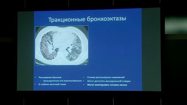 Тюрин И.Е. – Идиопатический лёгочный фиброз: семиотика и интерпретация данных ВРКТ