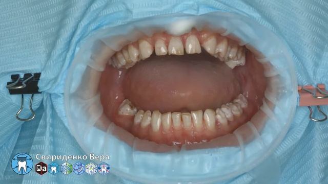 Professional oral hygiene -case 007 Acteon DTE Dentsply Coxo Floweis 3M KerrHawe (FHD multistream) смотреть онлайн