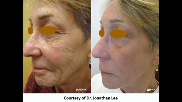 Фраксель в Роял Люкс клиник - Royal Lux Clinic