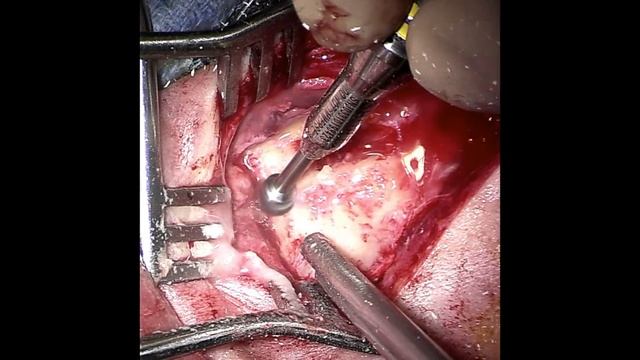 Mastoid Surgery (Basic To Radical Mastoidectomy)
