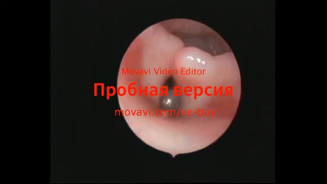 2 Коллапс гортани и медиальнонаправленное сближение рогов черпаловидных хрящей смотреть онлайн