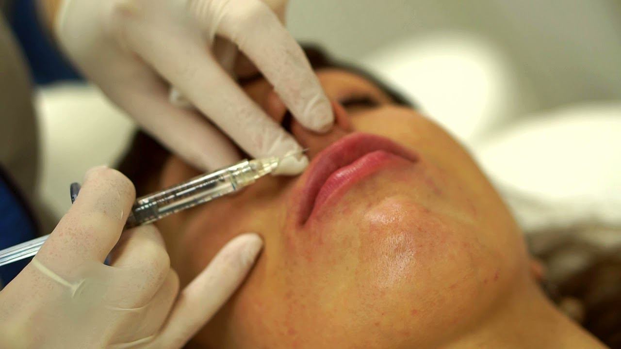 Контурная пластика губ. смотреть онлайн