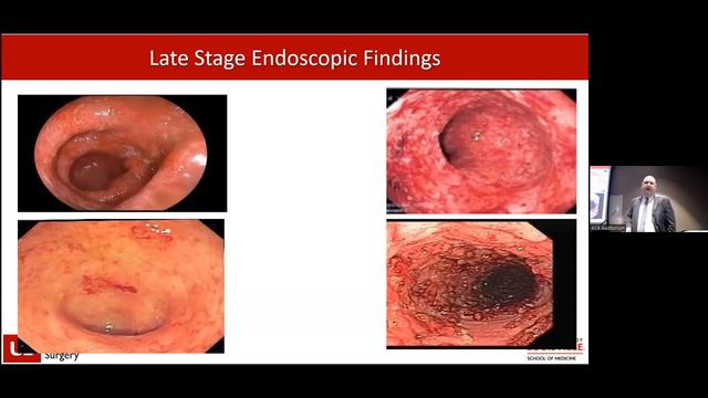 01.05.2024, "Ulcerative Colitis - A Surgical Zebra?" смотреть онлайн