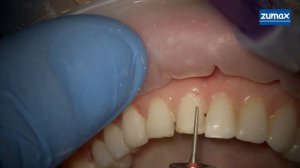 Препарирование зубов под виниры