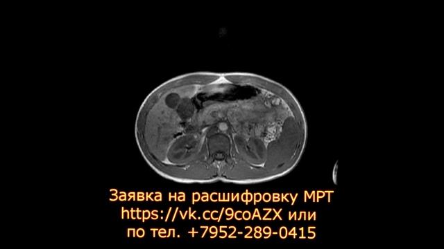 Второе мнение МРТ брюшной полости при пересмотре дисков МРТ смотреть онлайн