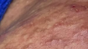 Acne Treatment For «Hung» (P7) | Điều Trị Mụn Cho Hùng (P7) -  SacDepSpa#202