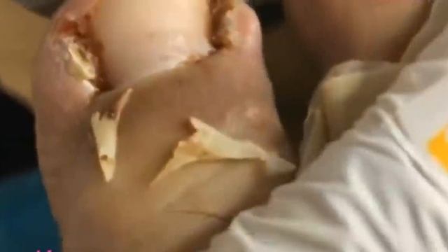 Вросшие ногти. Бяка смотреть онлайн