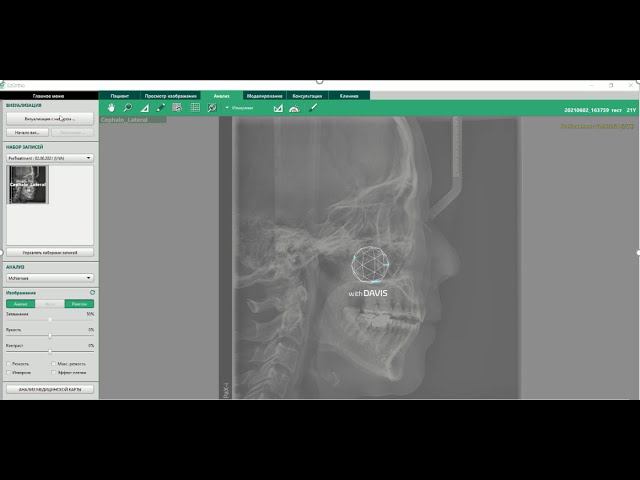 Программа EzOrtho для цифровой ортодонтии смотреть онлайн