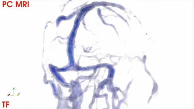 VTrails - NeuroVascular Image Analysis - Phase Contrast MRI смотреть онлайн