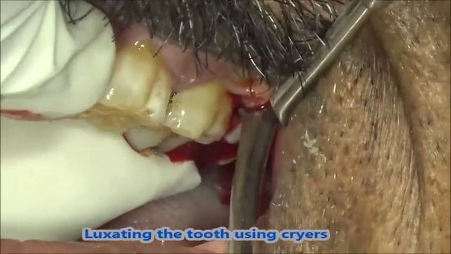 Infected upper wisdom tooth extraction using forceps смотреть онлайн