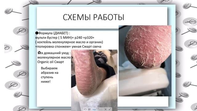 Диабетическая стопа. Особенности работы в Smart педикюре смотреть онлайн
