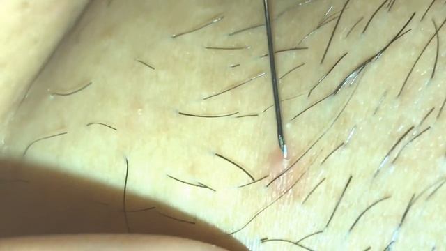 #2 NEW 2019 Satisfying Pimple Popping of Blackhead (Best Must Watch) Pluck Nasty Relaxing Easy Watc смотреть онлайн