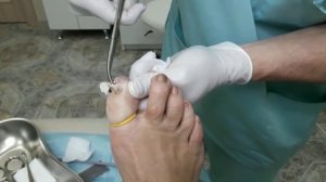 Удаление ногтя на ноге