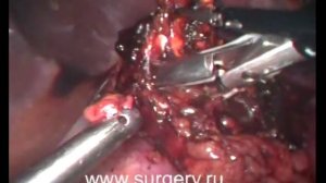 Лапароскопическое удаление правого надпочечника