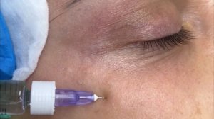 Биоревитализация Новокутан