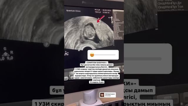 Узи первый скрининг смотреть онлайн