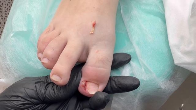 Вросший ноготь / Ноготь после удаления у подолога / Врос ноготь у ребенка, что делать? #вросший смотреть онлайн