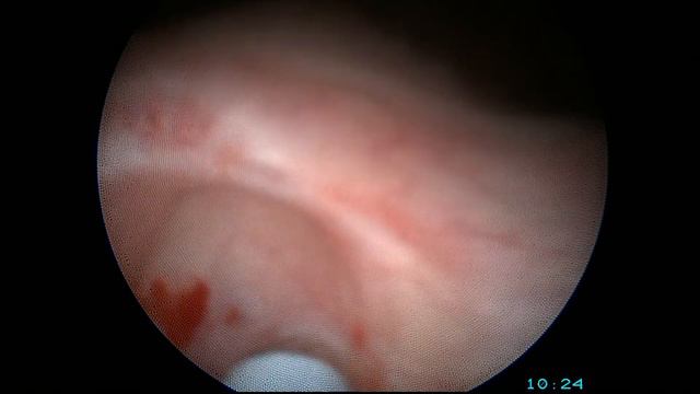 Эндопластика рецидивного ПМР уродексом смотреть онлайн