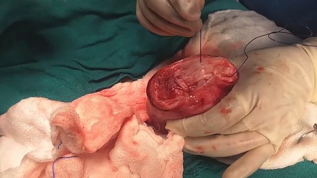Open Myomectomy смотреть онлайн