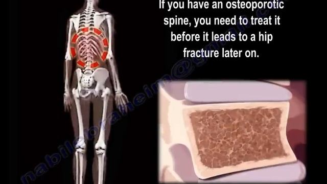 Low Back Pain - Everything You Need To Know - Dr. Nabil Ebraheim смотреть онлайн