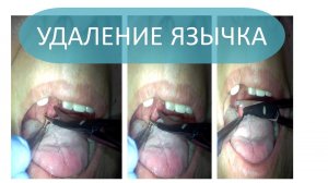 Частичное удаление язычка резекция нёбного язычка бескровная радиоволновая ЛОР хирургия от храпа