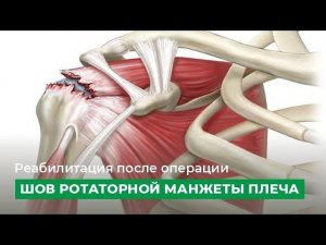 Реабилитация после операции «шов ротаторной манжеты плеча»