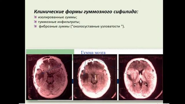13:50 третичный и врожденный сифилис смотреть онлайн