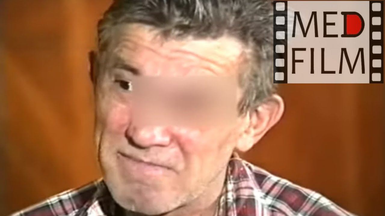 Алкогольная эпилепсия, концентрическое слабоумие, энурез © Сoncentric еpileptic Dementia