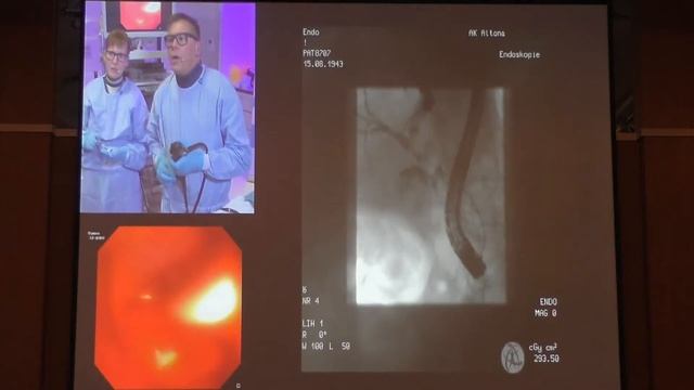 14 EndoClubNord Case T Baron Choledocholithiasis Lithotripsy Холедохолитиаз Эндоскопическая литотри смотреть онлайн