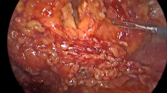 2023 03 03 Laparoscopic Left Partial Nephrectomy / Лапароскопическая Резекция Левой Почки смотреть онлайн